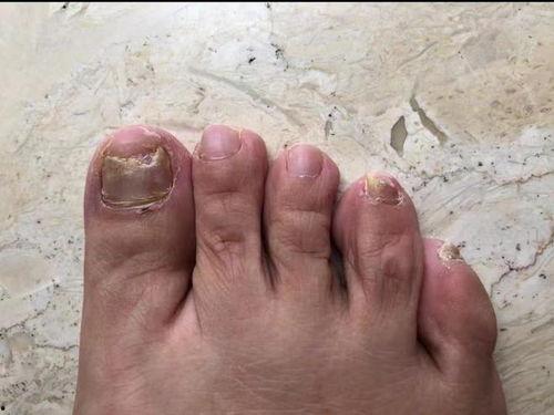 哪些明星网红有灰指甲,揭秘灰指甲的明星网红