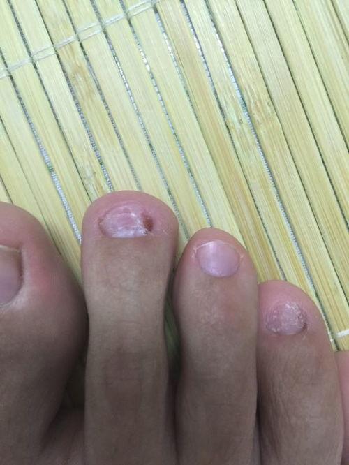 哪些明星网红有灰指甲,揭秘灰指甲的明星网红