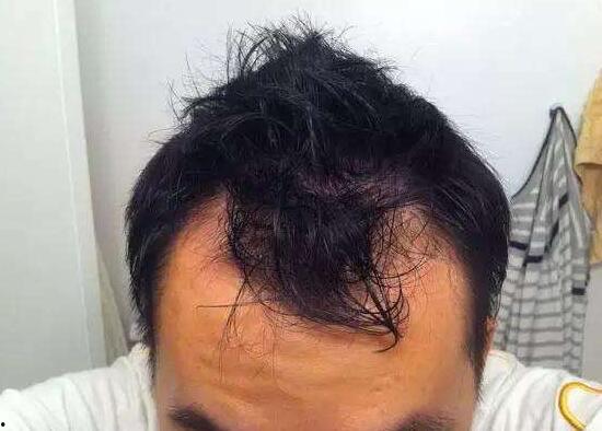 有遗传脱发的明星网红,揭秘遗传脱发背后的故事与应对之道”