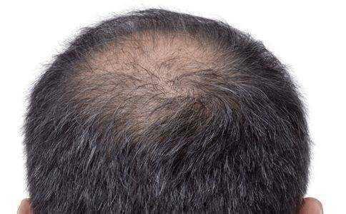 有遗传脱发的明星网红,揭秘遗传脱发背后的故事与应对之道”