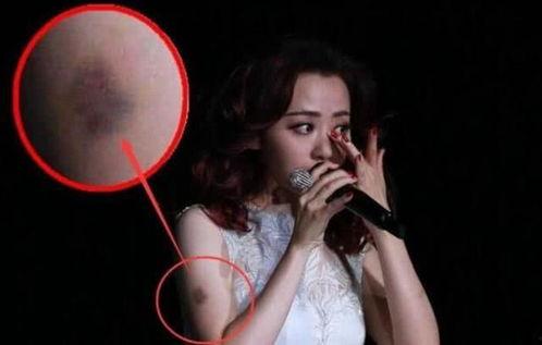 明星网红有骨折的吗,健康问题引发关注